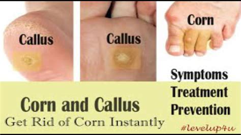 Corns And Callusescorn And Callus Differencecorn Treatmentcorns And Calluses Home Remedies