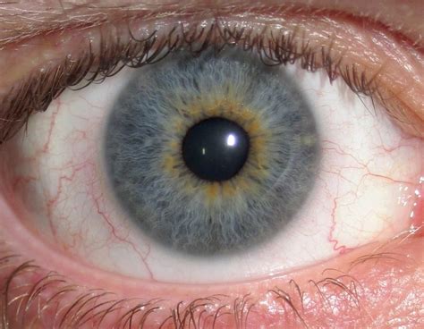 Cataracts Cheshire Eye Clinic