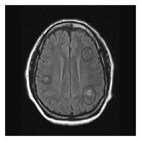 Mri Image Of The Brain In An Axial View Showing The “pre Contrast T2
