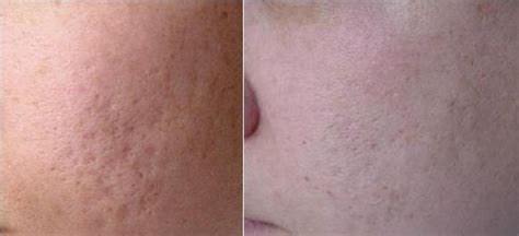 Pretty Filipinas Effective Way To Improve Your Pitted Scars Tca Cross
