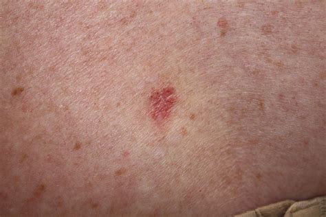 Basal Cell Carcinoma Appearance And Treatment Dermatology Consultants