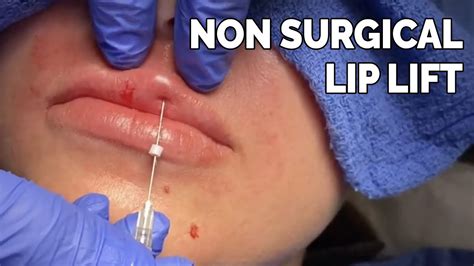 Non Surgical Lip Lift Youtube