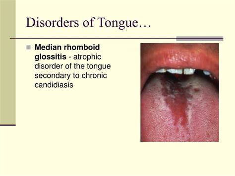 Ppt Diseases Of Oral Cavity Powerpoint Presentation Free Download