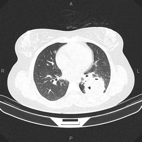 Chest Ct Scan Lungs