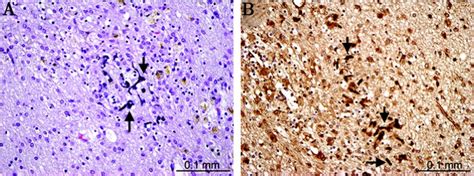 Diffuse Axonal Injury Histology