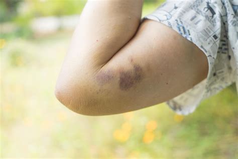 Badly Bruised Arm