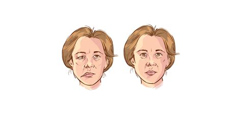 However, in rare cases, it can affect both sides. What chiropractic patients want to know about Bell's Palsy ...