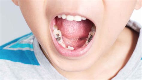 Cara Ampuh Mengatasi Gigi Berlubang Pada Anak