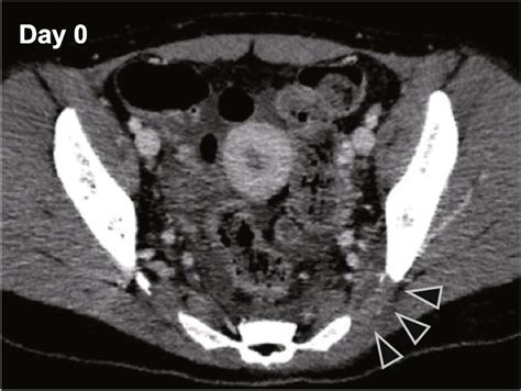 Pelvic Computed Tomography Image Upon Admission The Arrowhead