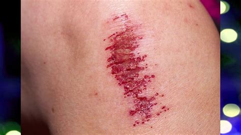 Cuts And Scrapes How Do You Treat A Minor Cut Or Scrape How To
