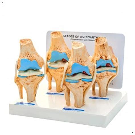 Knee Joint Arthritis Model 4 Stage Osteoarthritis At Rs 2250 Knee Joint Model In New Delhi