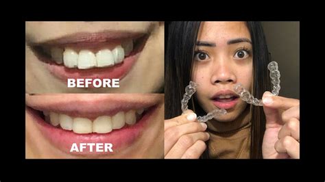 Does Invisalign Work Review Of My Invisalign Journey Overbite