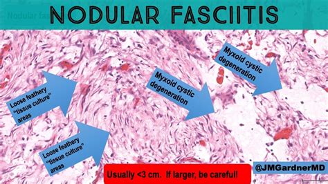 Nodular Fasciitis 101 Tips And Tricks For Diagnosis Pathology Dermpath