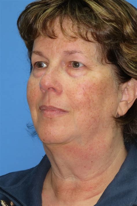 Facelift Before And After Photos Elite Facial Plastic Surgery