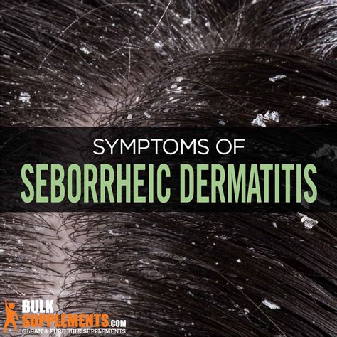 Seborrheic Dermatitis Symptoms Causes And Treatment By James Denlinger