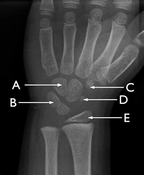 Radiograph Of The Ossification Centres Of A Childs Wrist The Bmj