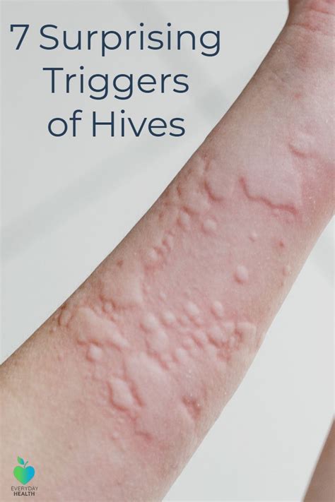 Exercise can induce an allergic reaction to food. 7 Surprising Triggers of Chronic Hives | Skin, Beauty ...