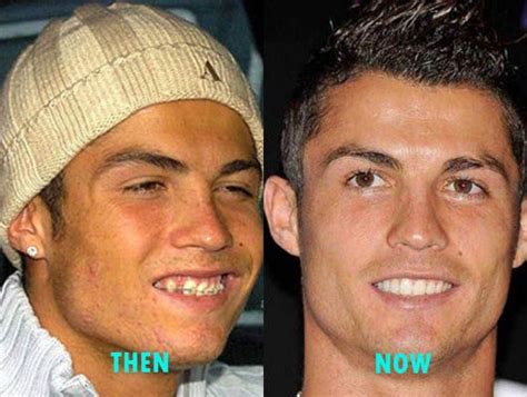 Cristiano Ronaldo Plastic Surgery Before And After Celebridades Sin
