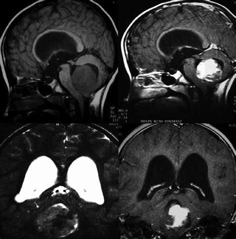 Preoperative Mri Images Of A Patient With Fourth Ventricular