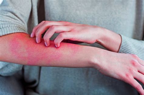 7 Itchy Skin Treatments To Stop Itching Forever