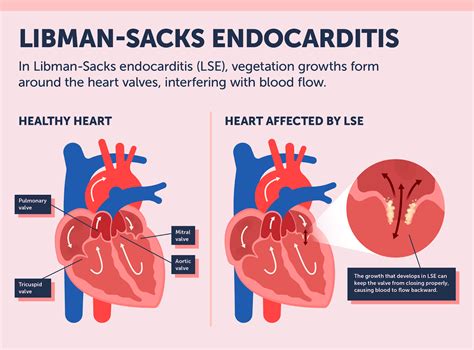 Libman Sacks Endocarditis Diagnosis Symptoms And Treatment