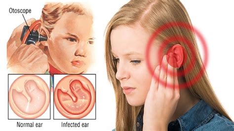 How To Get Rid Of An Ear Infection Fast Youtube