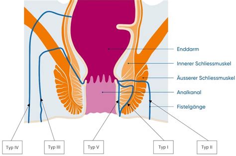 Analfisteln Universit Tsspital Z Rich