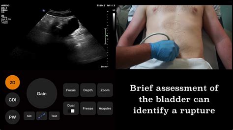 Ultrasound Tutorial Fast Focused Assessment With Sonography For