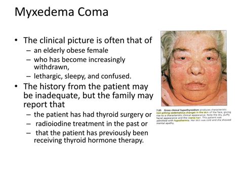 Myxedema Coma Scale