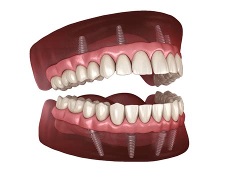 All On 4 Dental Implants Cost 13495 Implants Dentures Chicago