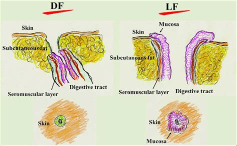 The Differences Between The Ductal Fistula Df And Labial Fistula Lf