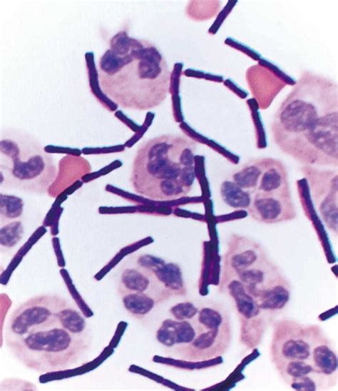Management Of Anthrax Meningitis The Lancet Infectious Diseases