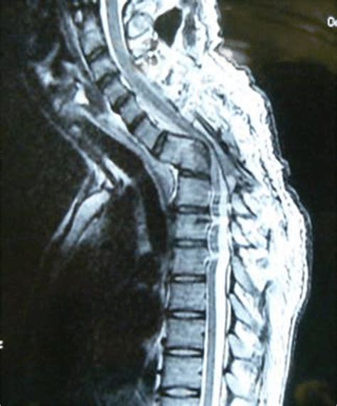 Kyphotic Deformity In Cervicodorsal Caries Spine Download Scientific