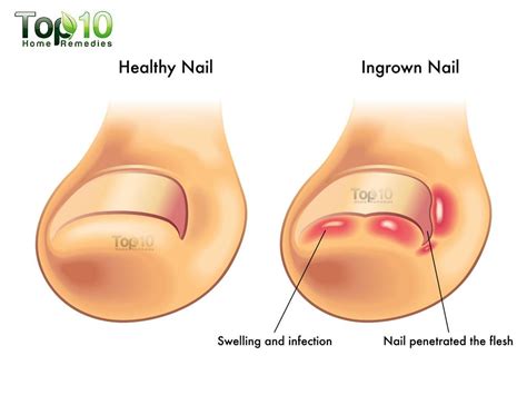 Even just cutting the nail can be very painful for your cat. Home Remedies for Ingrown Toenails | Top 10 Home Remedies