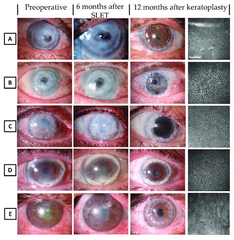 Clinical Course Of Simple Limbal Epithelial Transplantation SLET And