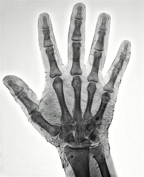 X Ray Of A Hand Dipped In Iodine Iodine Absorbs X Rays Revealing The
