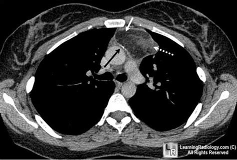 Mediastinal Teratoma Contrast Enhanced Axial Ct Scan Of The Chest