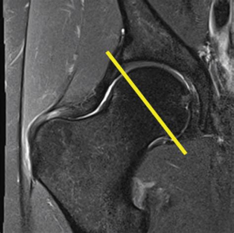 Demystifying Radial Imaging Of The Hip Radiographics