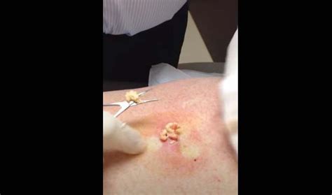 Dr Pimple Popper Sebaceous Cyst On Back New Pimple Popping Videos