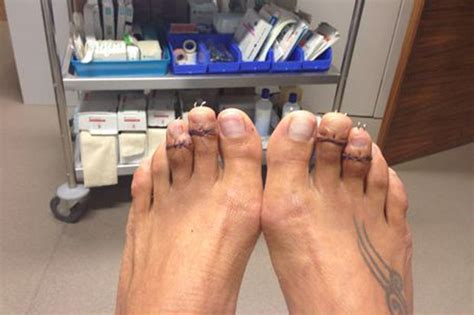 Toe Shortening Surgery And Foot Botox Daily Star