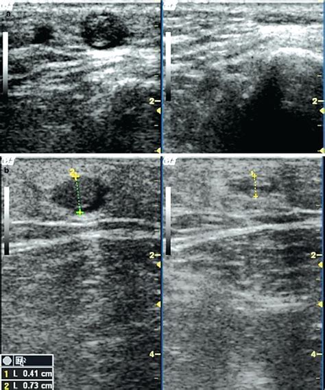 Superficial Vein Thrombosis Radiology Key