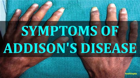 Symptoms Of Addisons Disease Youtube