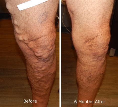Varicose Vein Treatment Before And After Photos Varicose Vein