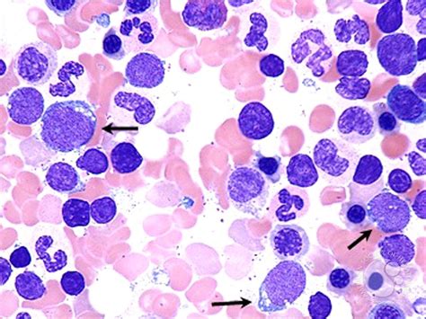relapsed precursor b cell acute lymphoblastic leukemia 2