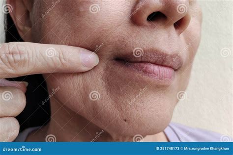 The Flabbiness Adipose Sagging Skin Beside The Mouth Wrinkles And