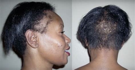 7 Ways To Grow Your Edges Back And Treat A Thinning Hairline Thinning