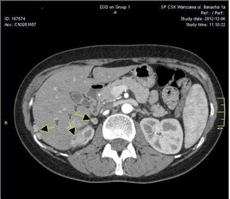 Preoperative Ct Scan From 2007 Tumor Of The Right Adrenal Gland 67x48