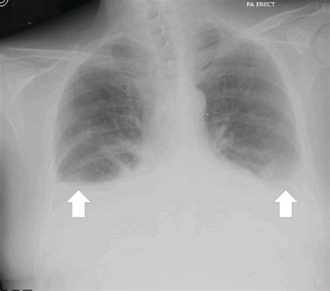 Chest X Ray Shows Scanty Bilateral Pleural Effusion And Focal Increased