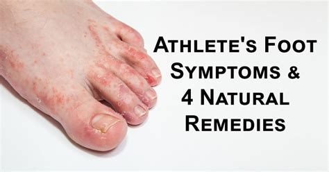 Athletes Foot Symptoms And 4 Natural Remedies