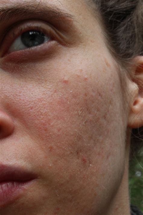 Designyourcell Pitted Acne Scar Treatment